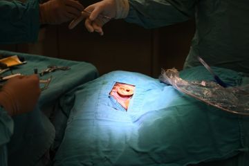 Cochlear implant surgeries start on people with hearing deficiency with support of Heydar Aliyev Foundation  - VIDEO