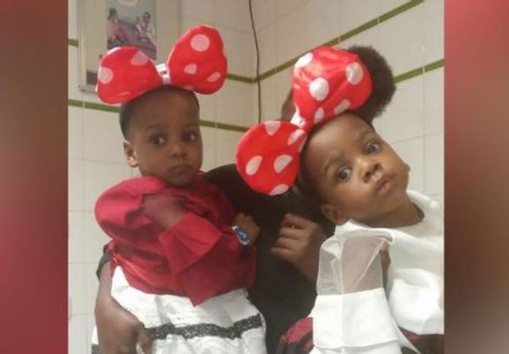 Nigerian conjoined twins successfully separated by 78-member team in Abuja - PHOTO