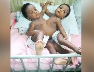 Nigerian conjoined twins successfully separated by 78-member team in Abuja - PHOTO
