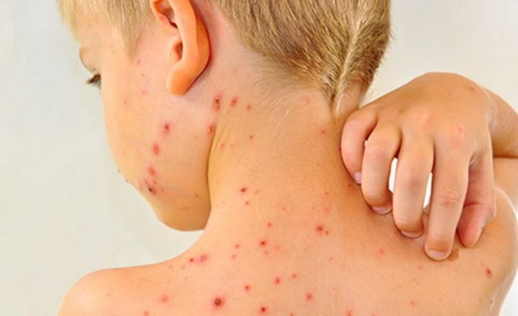 3 people died of measles in Azerbaijan last year