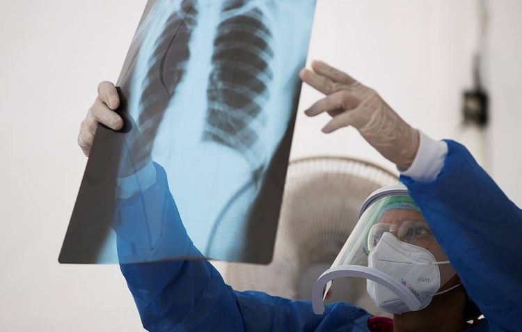 Number of COVID-2019 cases across globe up by over 542,000 in past day