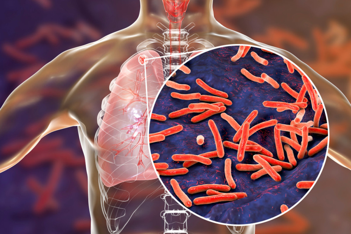Japan to provide Azerbaijan with TB diagnostics device
