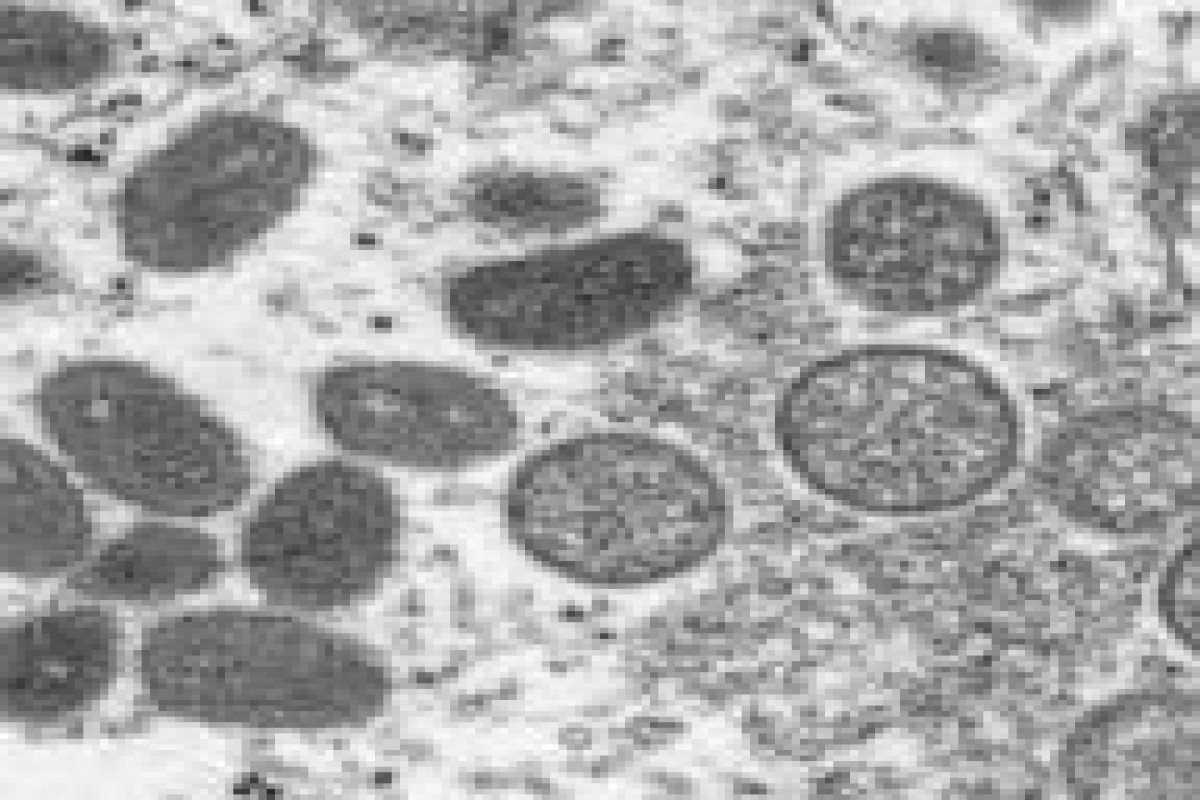 2 new cases of monkeypox in kids reported in US