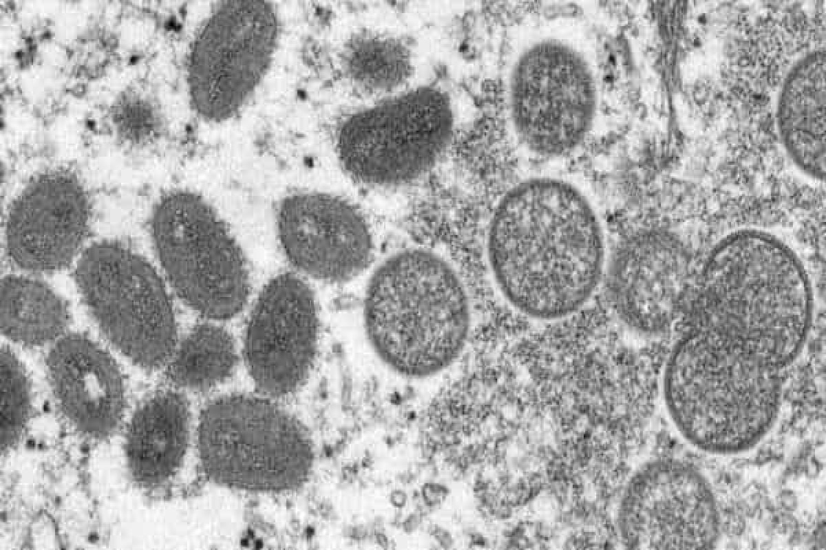 WHO calls for urgent action as Monkeypox cases in Europe triple in two weeks