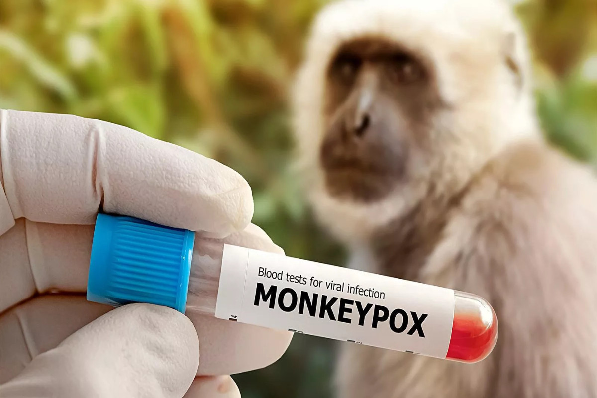 First case of monkeypox confirmed in Russia