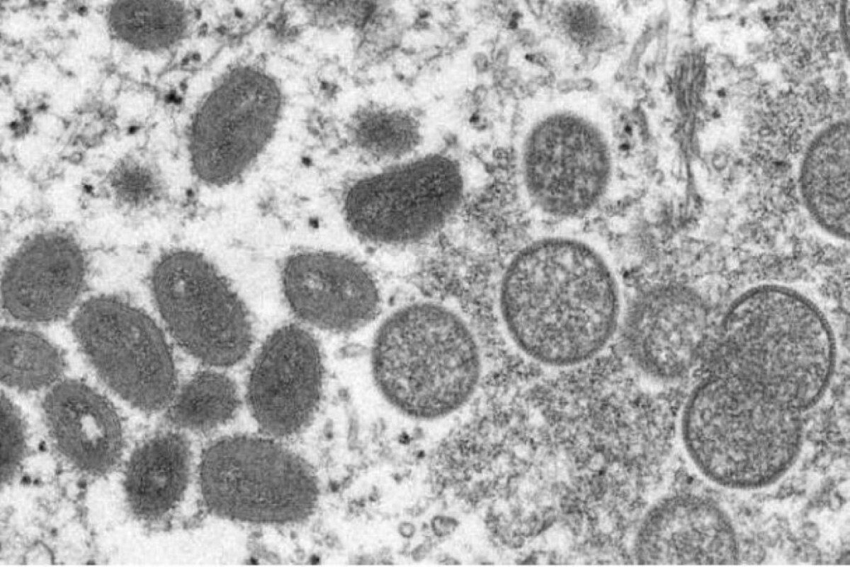 New York reports 1st US polio case in nearly a decade