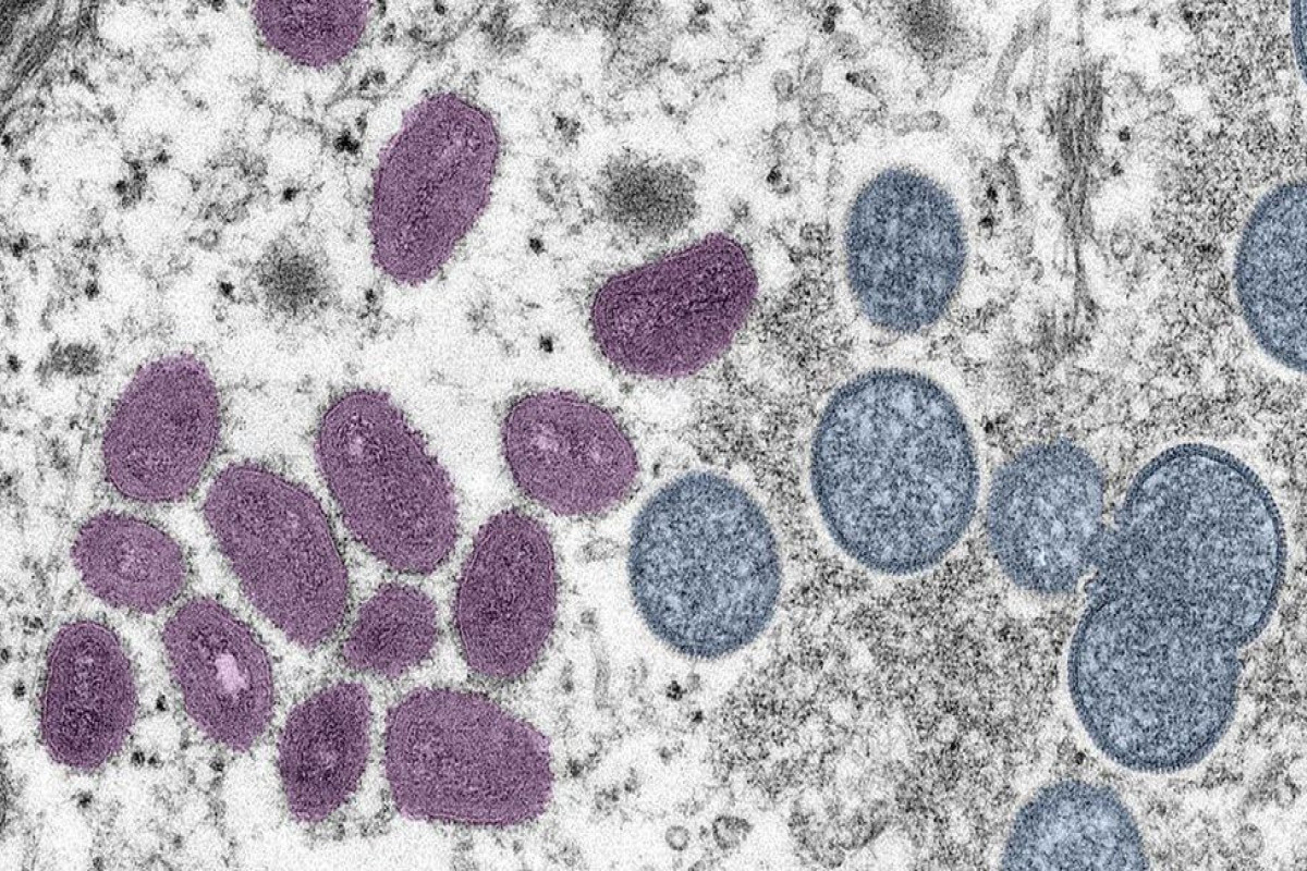 US confirms first two Monkeypox cases in children