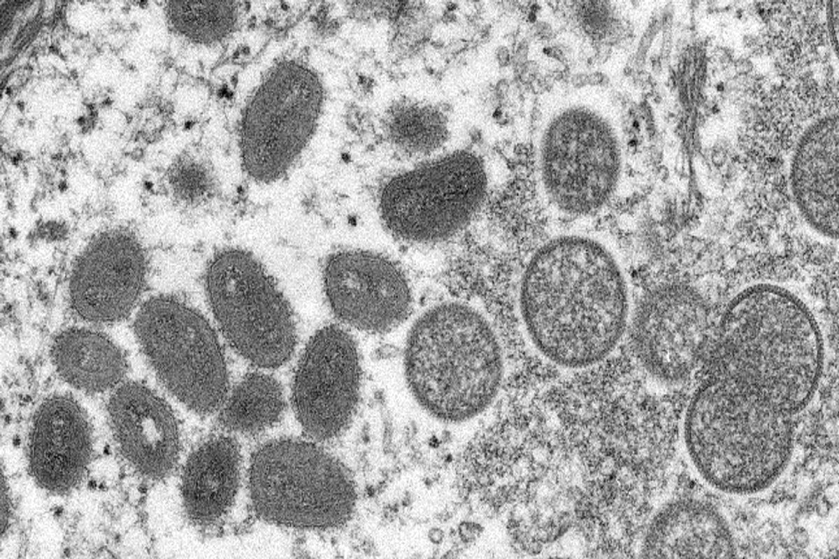 Over 400 monkeypox cases registered in Italy