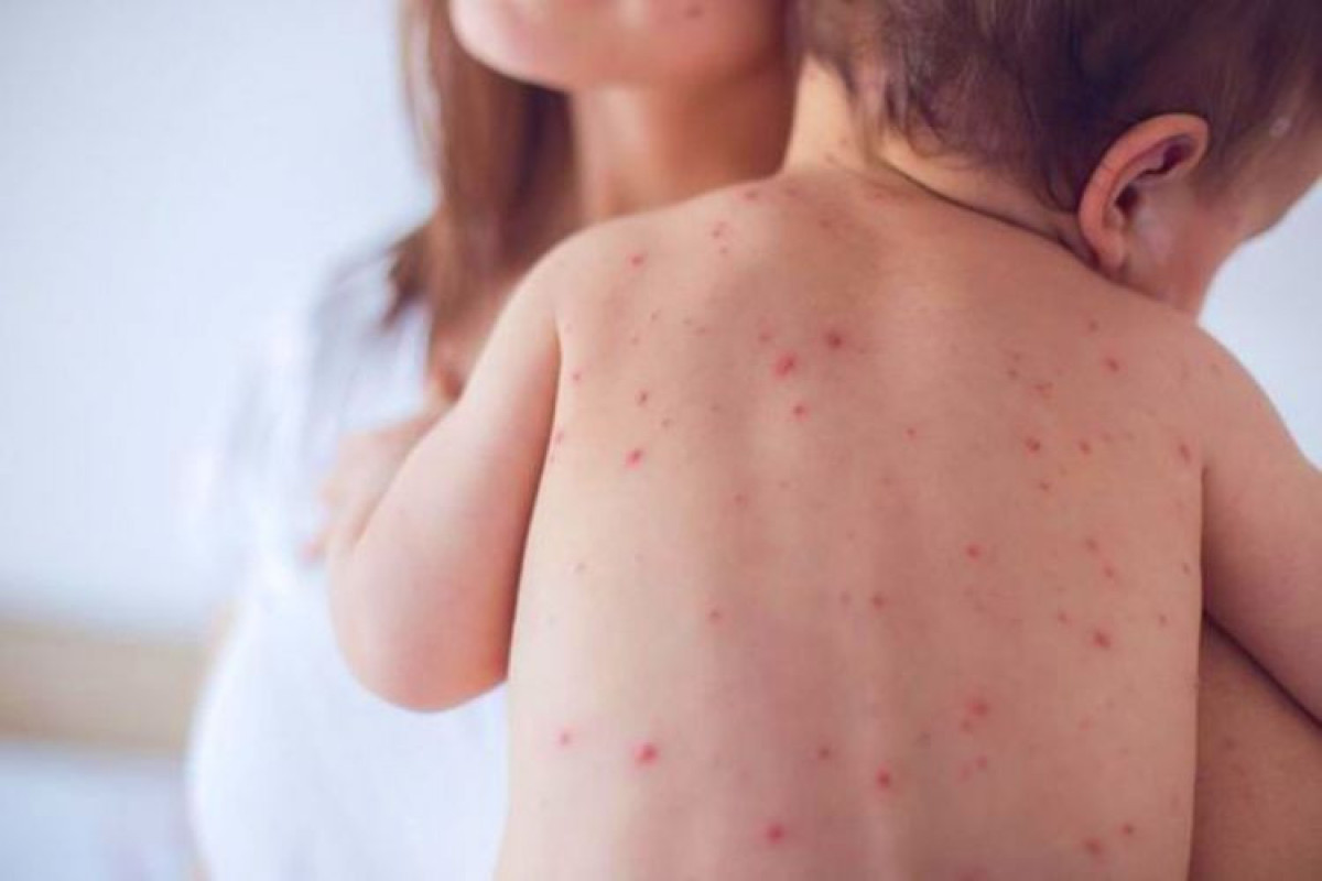 WHO: Sharp increase is observed in the number of measles infections in Europe