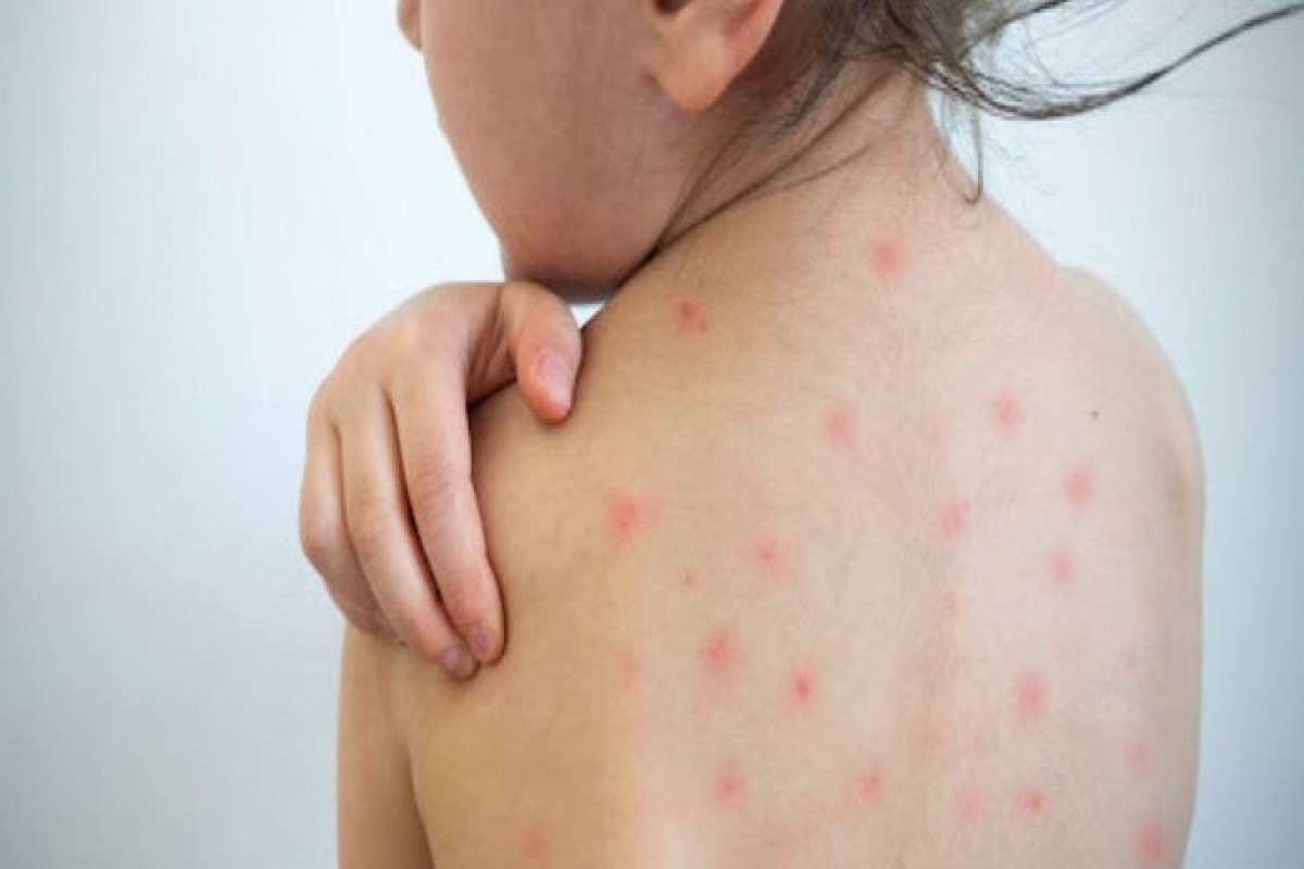 Azerbaijan unveils latest situation regarding measles