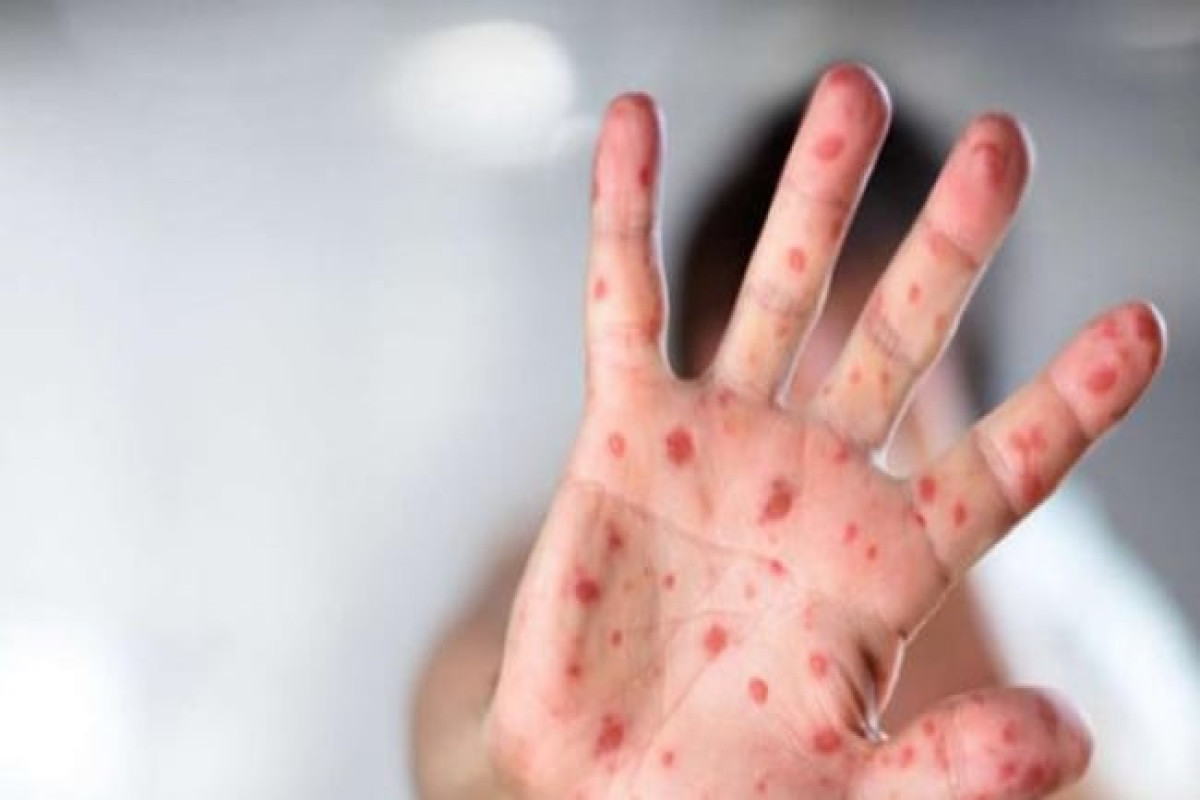 Global measles threat will continues unless children not vaccinated - WHO