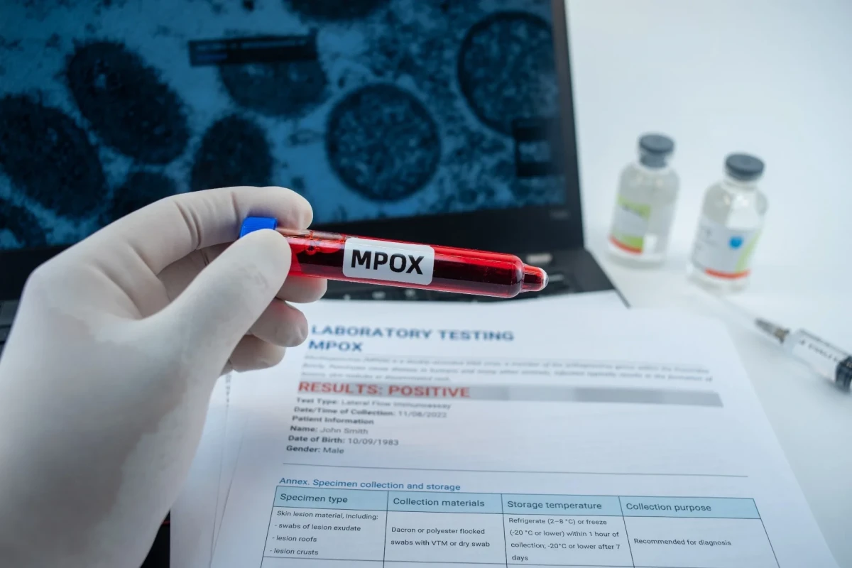 Health Ministry says no mpox cases detected in Türkiye