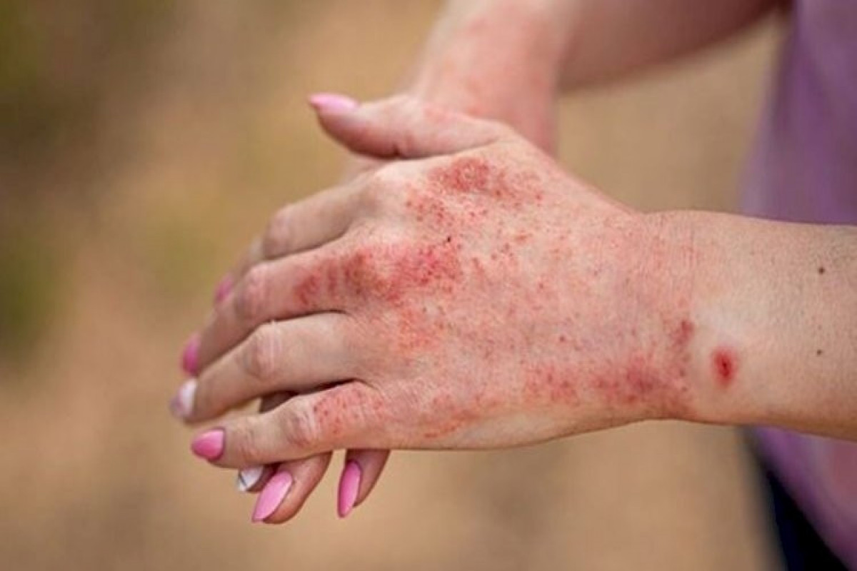 Azerbaijan reveals number of people infected with measles