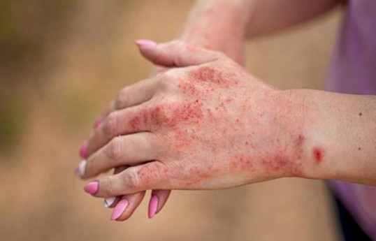 Azerbaijan reveals number of people infected with measles