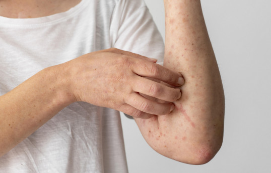 Azerbaijan sees decrease in measles infection