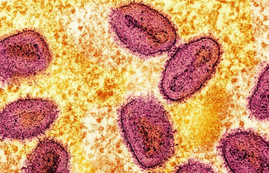New Clade Ib mpox case detected in Britain