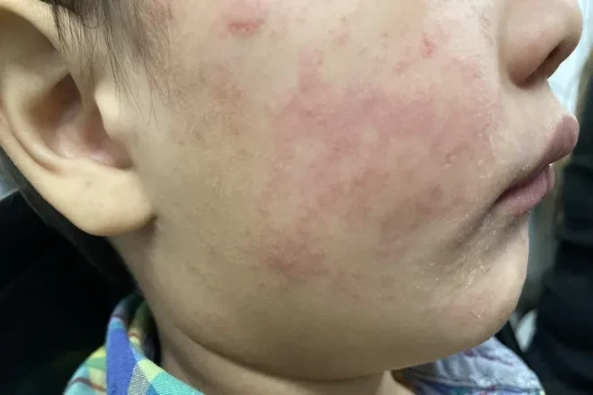 Measles outbreak spreads in U.S.